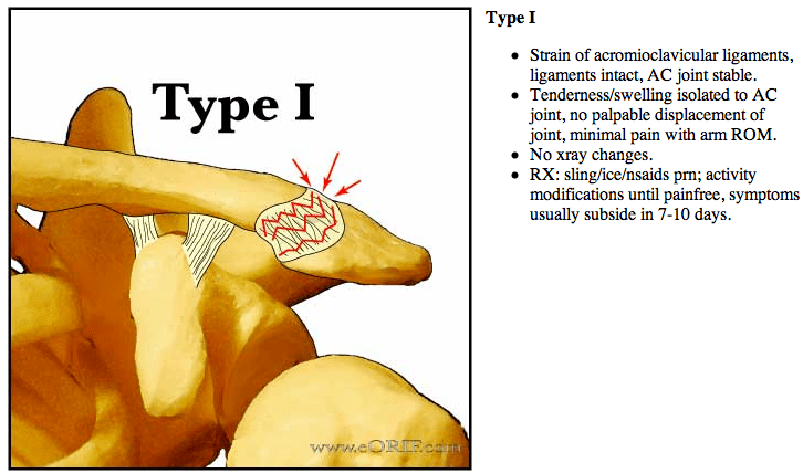 Acromioclavicular Joint Separations S43.109A 831.04 eORIF